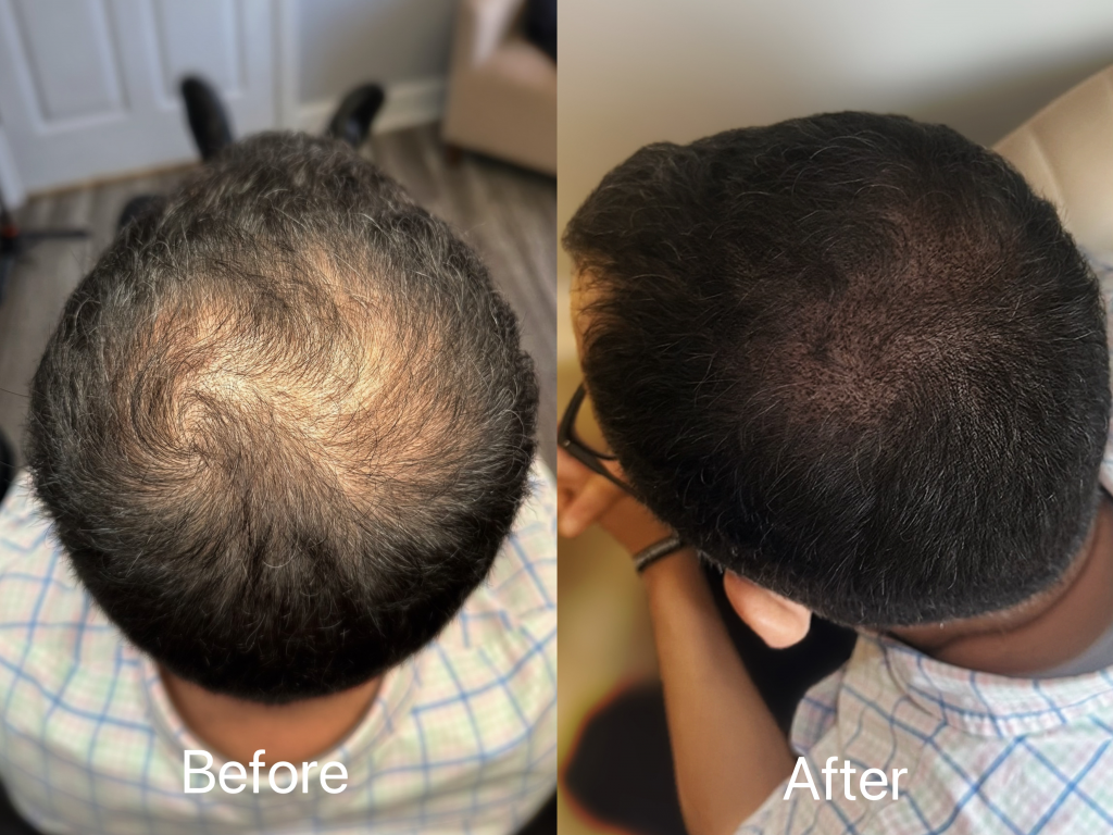 Scalp Micropigmentation treatement in madison alabama. Hair restore in Madison, Alabama